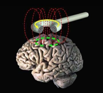 Magnet Test Finds Cortex Overexcitable In All Als Alzforum